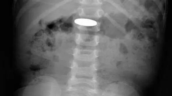 تهدید معده کودکان با باتری دکمه ای