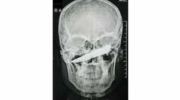 خارج کردن چاقو از صورت مرد آفریقایی
