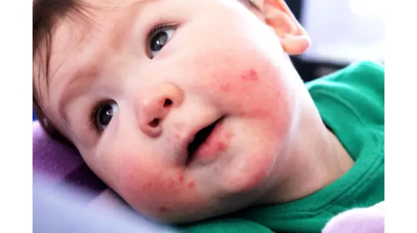 ربطه اگزمای کودکان و ویتامین ب