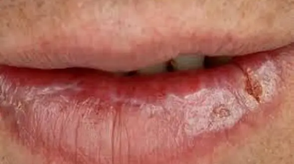 سرطان لب / چه کسانی مبتلا می شوند 
