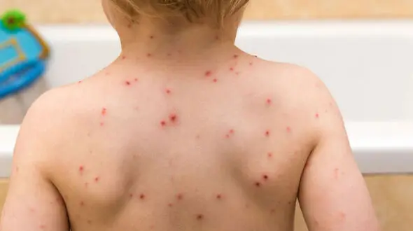 شایع ترین سن ابتلا به آبله مرغان 