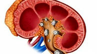 راه حل هایی فوری برای درمان سریع سنگ کلیه