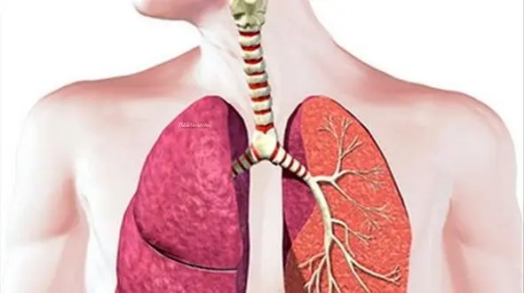 بیماری پنومونی چیست؟ / همه چیز درباره این بیماری