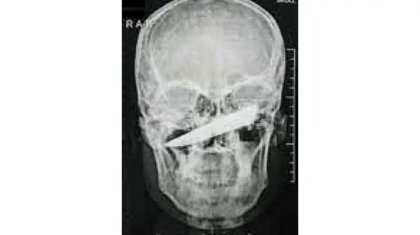 خارج کردن چاقو از صورت مرد آفریقایی + عکس