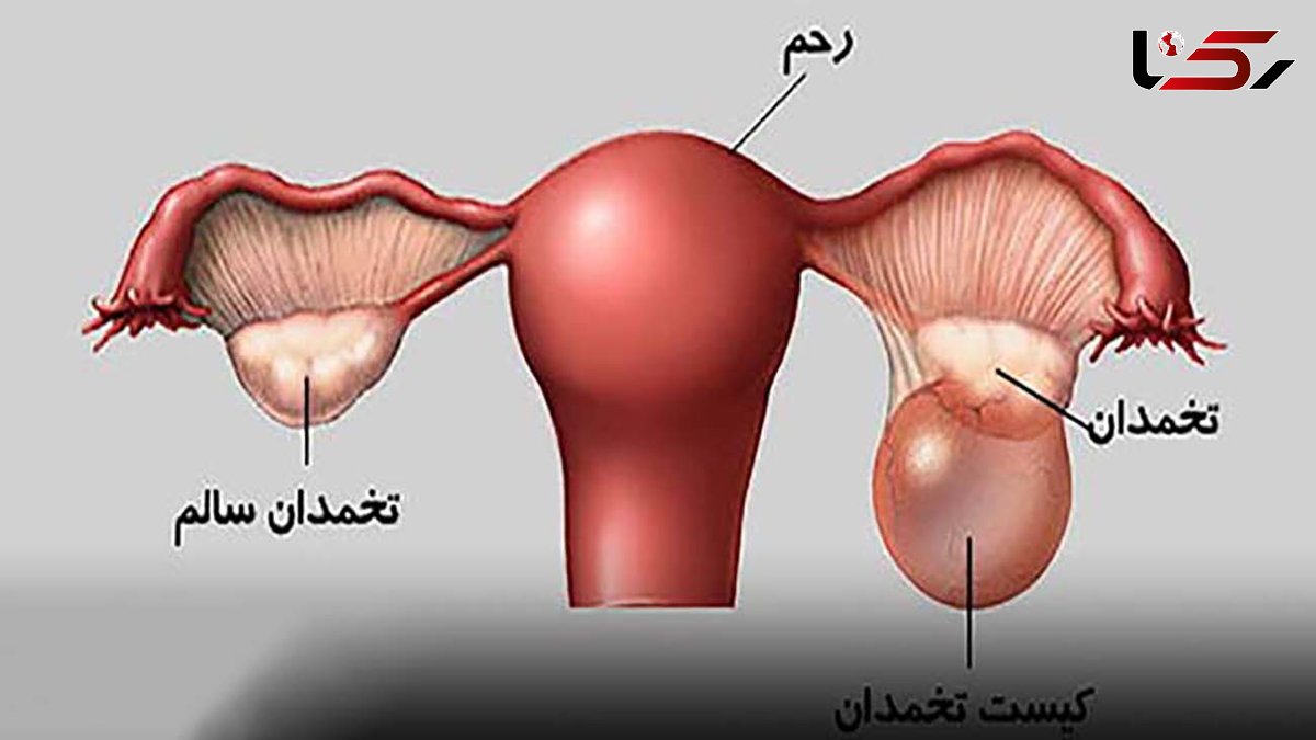 عوارض پارگی کیست تخمدان