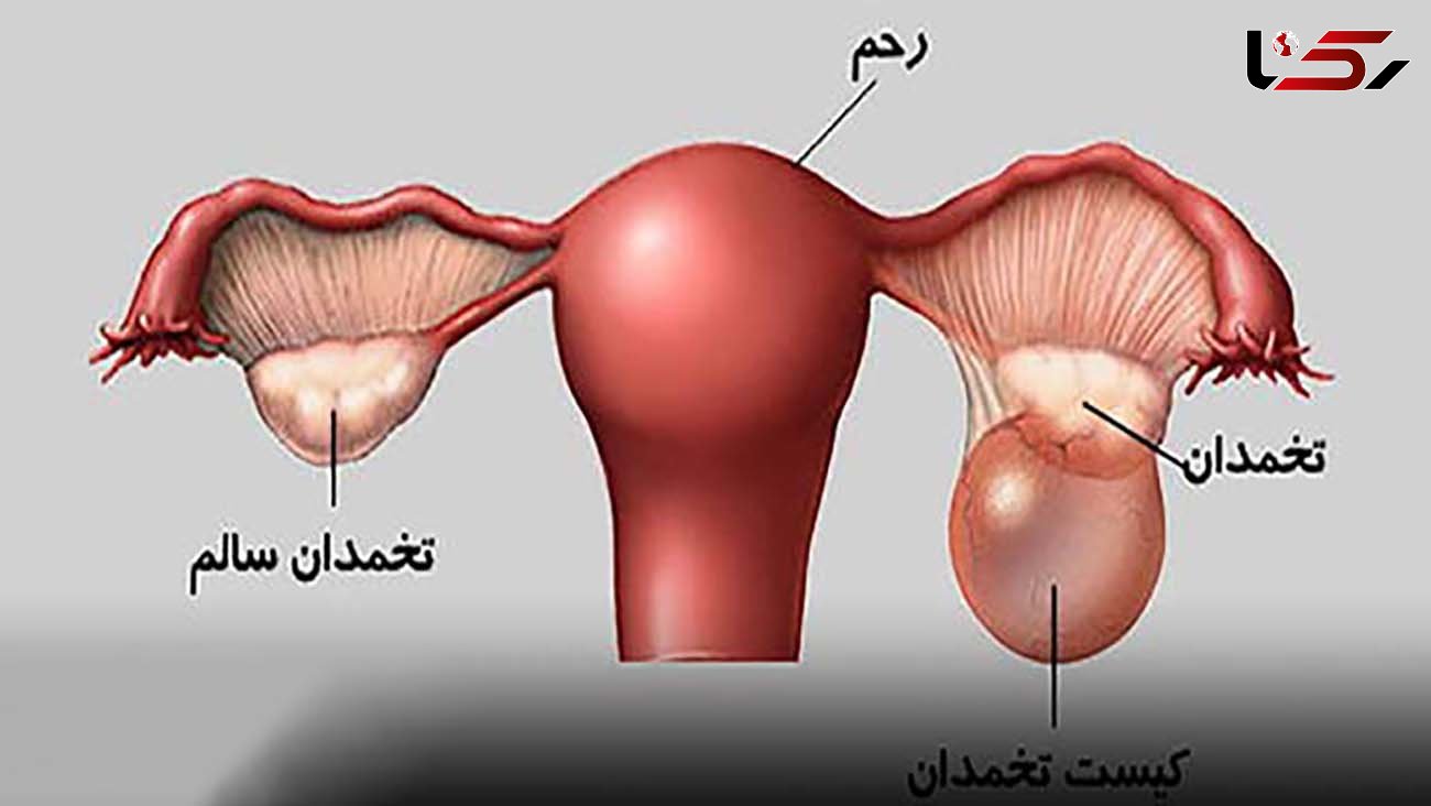 عوارض پارگی کیست تخمدان