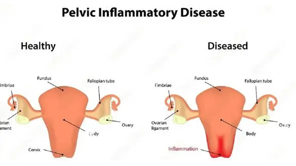 PID چیست؟ + فیلم