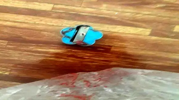 عکس مدادتراش خونینی که درگلوی کودک یاسوجی گیرکرده بود! / یک معجزه شد