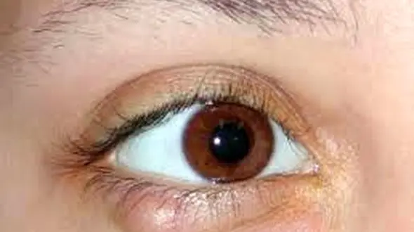 چرا چشم ها به گل مژه مبتلا می شوند؟