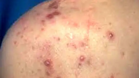 نشانه های جوش های کمر و شانه را بشناسید