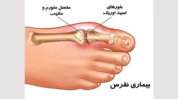 عوامل تشدیدکننده نقرس + اینفوگرافی