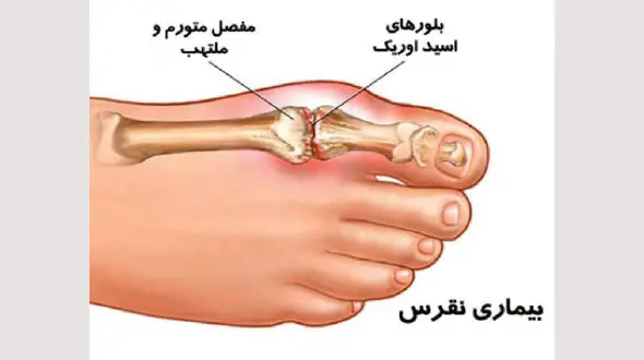 عوامل تشدیدکننده نقرس + اینفوگرافی