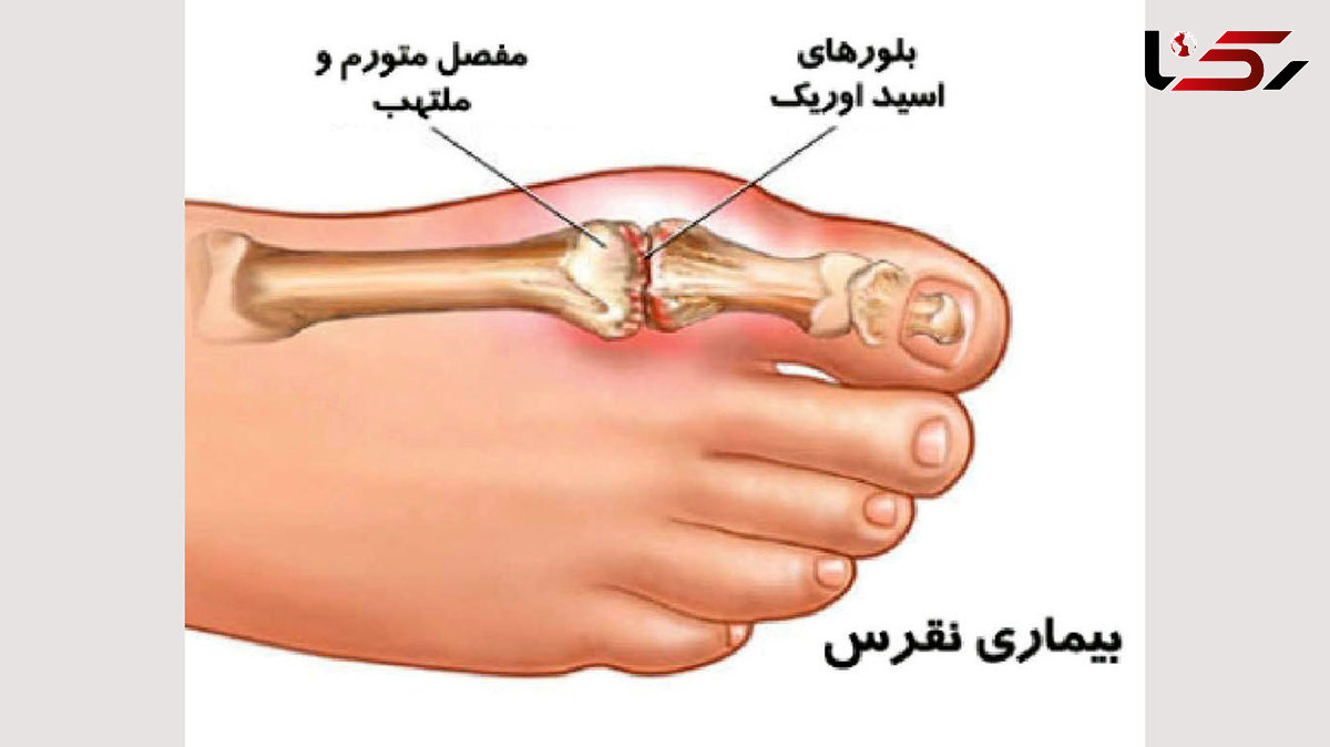 عوامل تشدیدکننده نقرس + اینفوگرافی