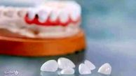 هزینه خدمات لمینت دندان در دکترتو کلینیک + تخفیف