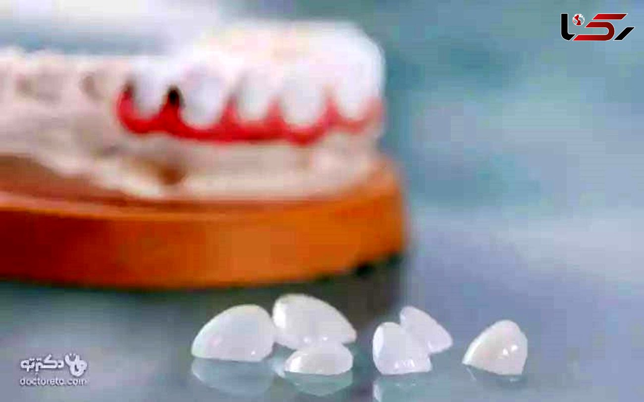 هزینه خدمات لمینت دندان در دکترتو کلینیک + تخفیف