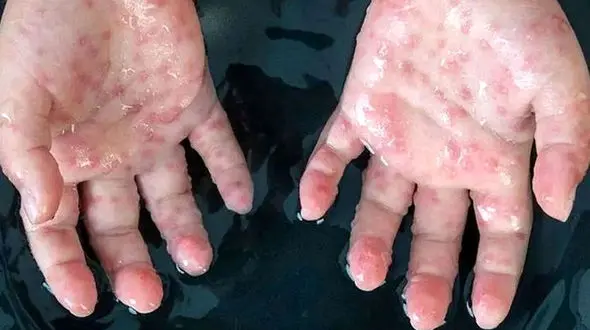 خطر آبله میمون در ایران / 6 بیمار مشکوک / مرزهای ایران تحت نظر