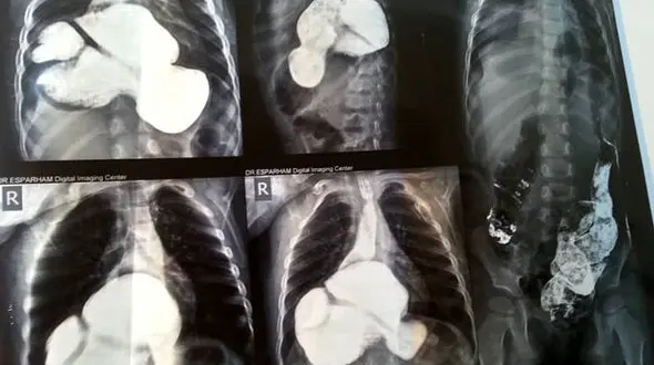 به دنیا آمدن کودک عجیب الخلقه در تربت حیدریه + عکس