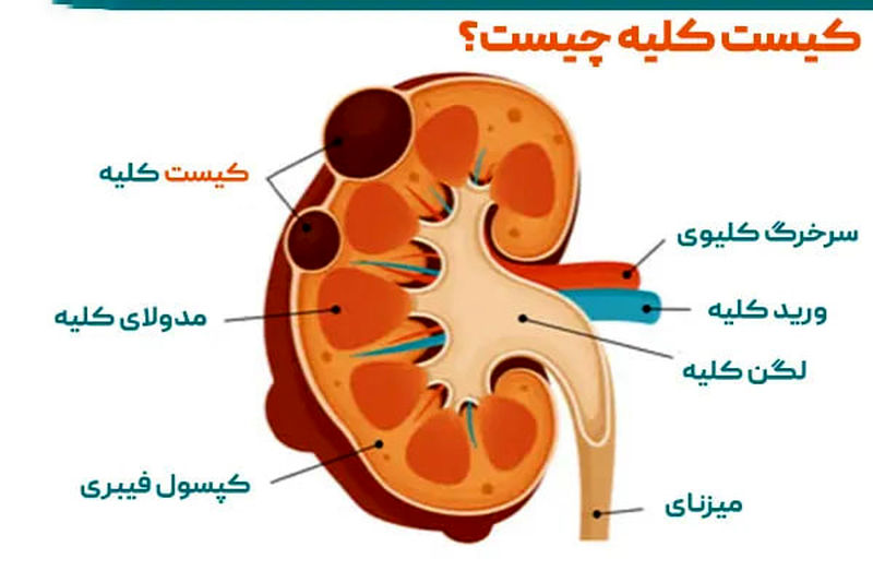 کیست کلیه