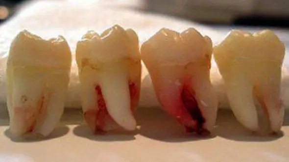 مقاومت عجیب دندان عقل در برابر فشار + فیلم