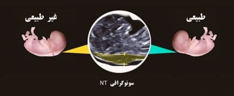 سونوی ان تی