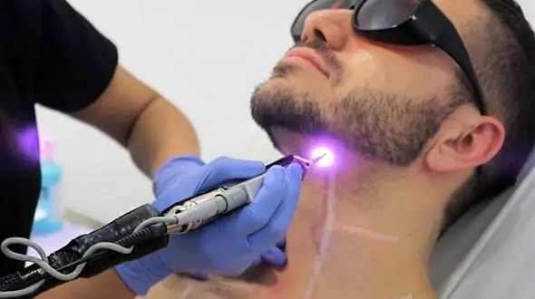 همه چیز در خصوص لیزر مو (هزینه،روش،عوارض، مزایا)