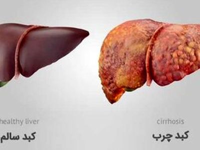 پیشگیری از کبد چرب با تغییرات ساده در سبک زندگی