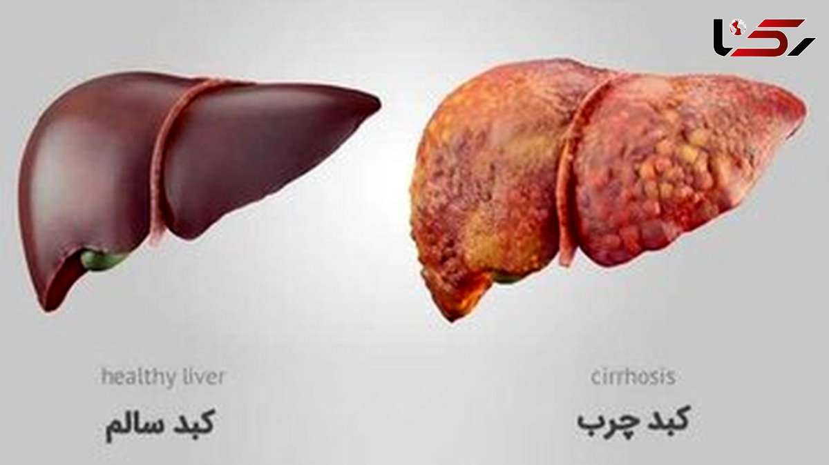  پیشگیری از کبد چرب با تغییرات ساده در سبک زندگی 