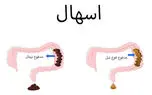 اسهال آبکی نشانه چیست؟ / از علل تا درمان