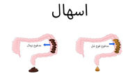 اسهال آبکی نشانه چیست؟ / از علل تا درمان