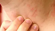 عرق‌ سوزی را دست‌کم نگیرید؛ این اشتباهات ساده التهاب پوست را تشدید می‌ کند
