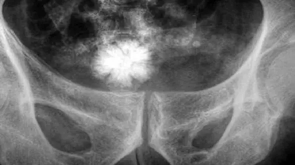 سنگ مثانه چرا ایجاد می شود؟ / راه درمان سنگ مثانه چیست؟