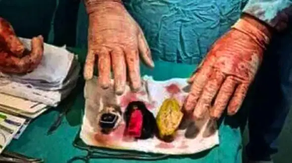 راز شکم برآمده مرد 30 ساله چه بود ؟ / پزشکان وحشت کردند + عکس / مصر