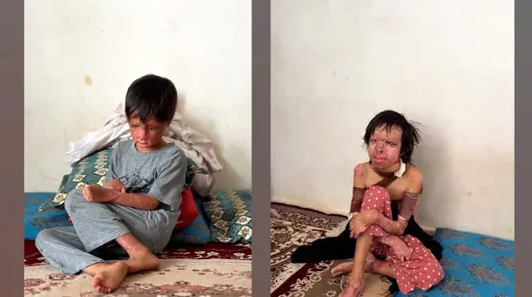 فیلم سرنوشت آتشین 4 عضو خانواده اصفهانی /  زندگی بعد از سوختن شدید بدن هایشان !