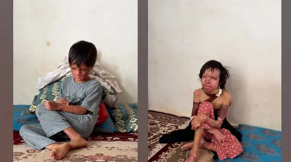 فیلم سرنوشت آتشین 4 عضو خانواده اصفهانی /  زندگی بعد از سوختن شدید بدن هایشان !