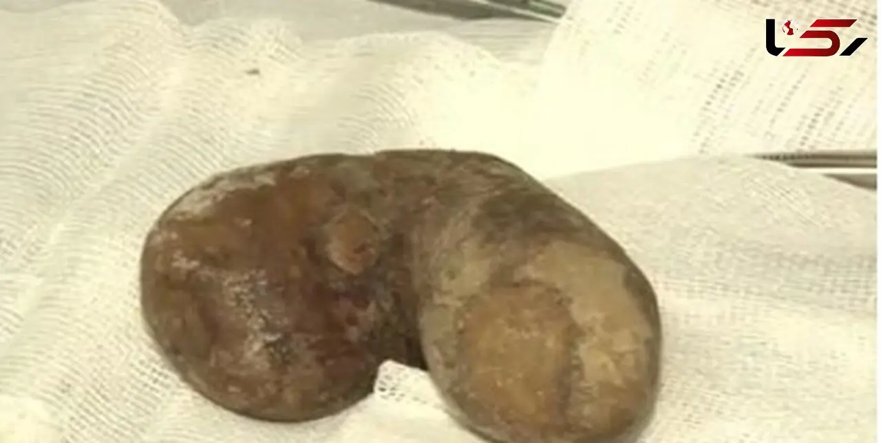 دفع سنگ کلیه با این داروی جدید 