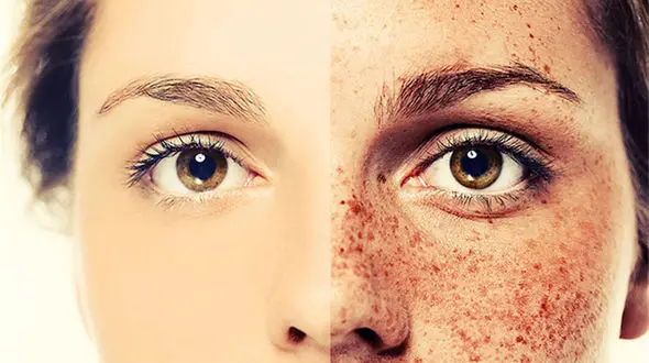 اگر کک و مک پوستی دارید این مطلب را بخوانید 