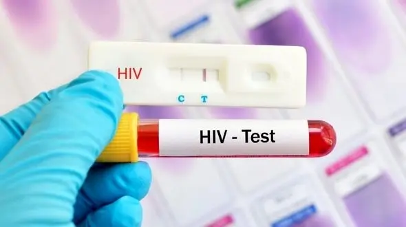 مناسب‌ترین زمان آزمایش ایدز + علائم اصلی بیماری ایدز