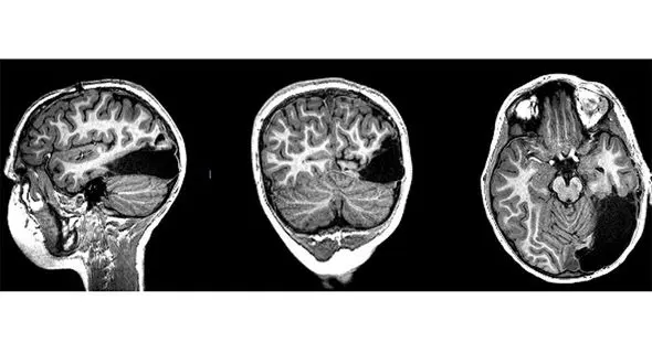 ترمیم باورنکردنی مغز پسر ۷ ساله +عکس