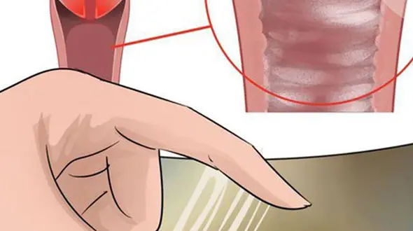 یک راهکار برای ترشحات غیرطبیعی رحم