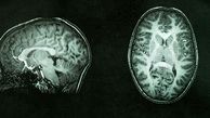 Measuring brain tissue damage can identify cognitive decline