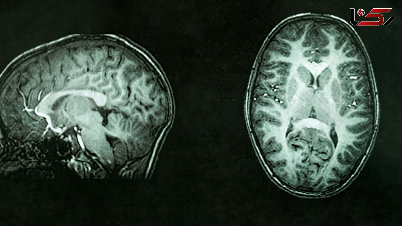 Measuring brain tissue damage can identify cognitive decline