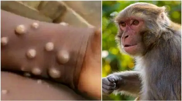 موردی از ابتلا به آبله میمون در ایران گزارش نشده است / آبله میمون چگونه منتقل می شود؟ 