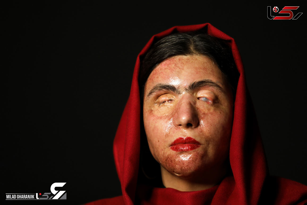 دختر اسید سوخته ایرانی جذاب ترین مدل جهان ! + فیلم گفتگو و عکس های شیک معصومه عطایی
