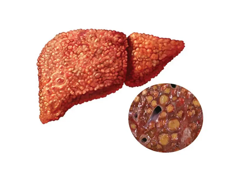سیروز کبدی