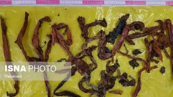  خروج حجم زیادی اجسام خارجی از معده یک بیمار +عکس 