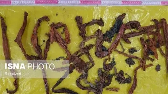 خروج حجم زیادی اجسام خارجی از معده یک بیمار +عکس 