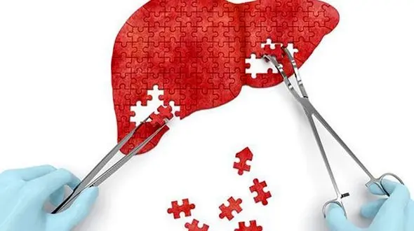 باید و نبایدهای تغذیه ای برای مبتلایان به کبد چرب