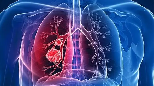 چگونه فرق سرطان ریه و ابتلا به کرونا را تشخیص دهیم؟