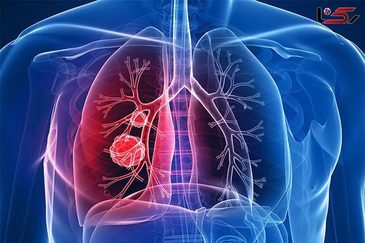 چگونه فرق سرطان ریه و ابتلا به کرونا را تشخیص دهیم؟