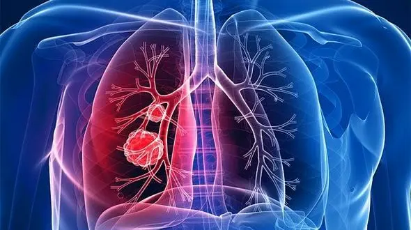 دلایل اصلی سرطان ریه 